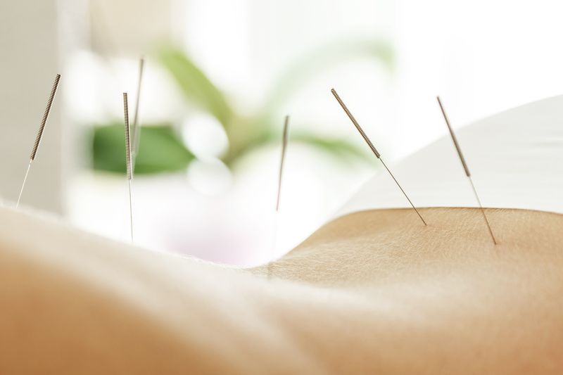 Behandling med akupunktur. 